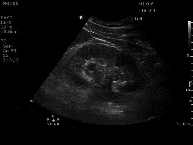Renal/GU - Mild Hydronephrosis