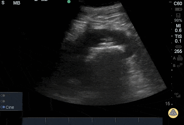 Renal/GU - Staghorn Calculi
