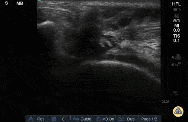 Musculoskeletal - Right Patellar Tendon Rupture