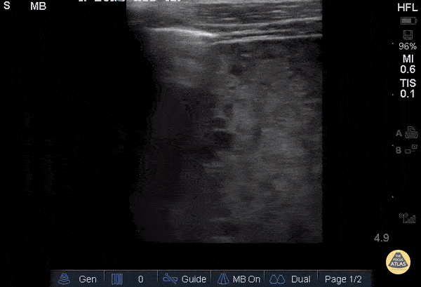 Pulmonary - Lung Consolidation