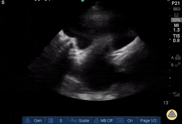 OB/Gyn - Hematocolpos