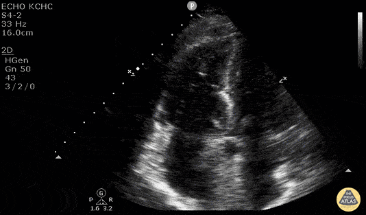Right Ventricular Dysfunction - McConnell's Sign - Pulmonary Embolism