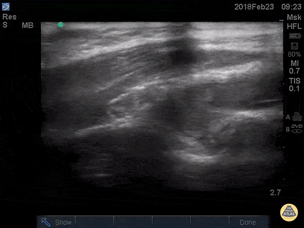 Musculoskeletal - Posterior Fat Pad