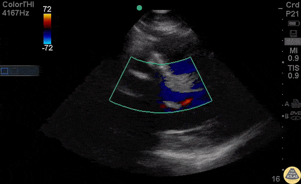 Other Cardiac Pathology - Truncus Arteriosus