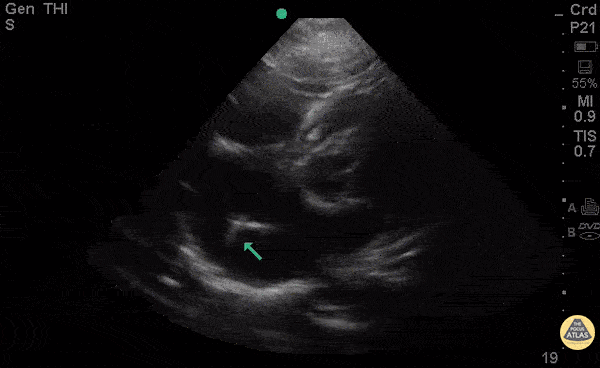 Other Cardiac Pathology - Truncus Arteriosus