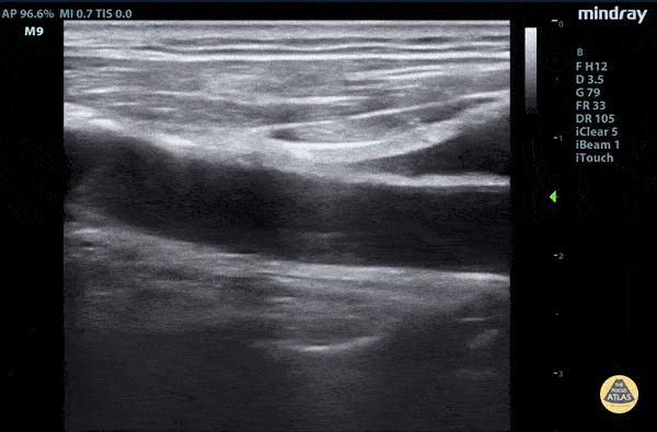 Aorta - Aortic dissection flap tamponade