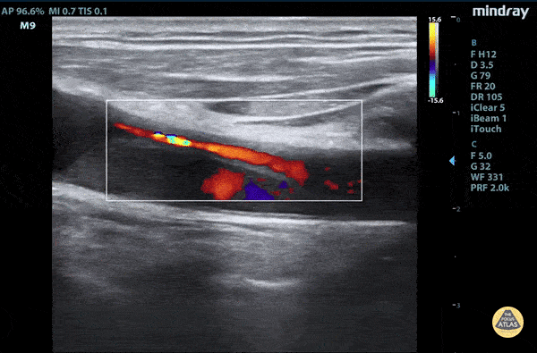 Aorta - Aortic dissection flap tamponade color flow