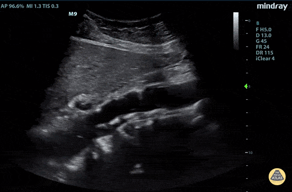 Aorta - Aortic Dissection Flap