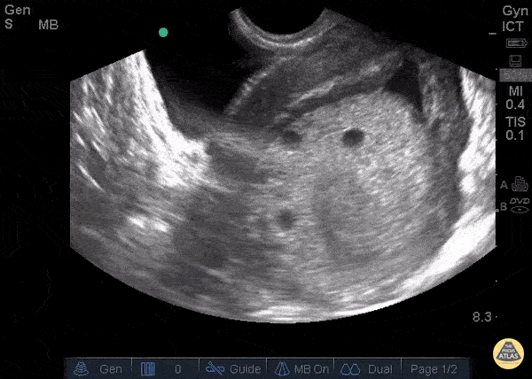 OB/Gyn - Molar Pregnancy