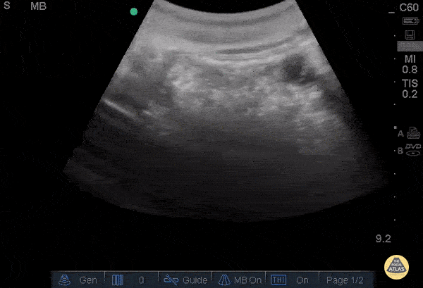 Bowel-GI - Enlarged pylorus with gastric outlet obstruction