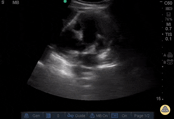 Renal/GU - Severe Hydronephrosis - Congenital