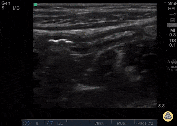 Bowel-GI - Normal Appendix blind end