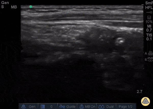 Bowel-GI - Normal Appendix - Cross Section