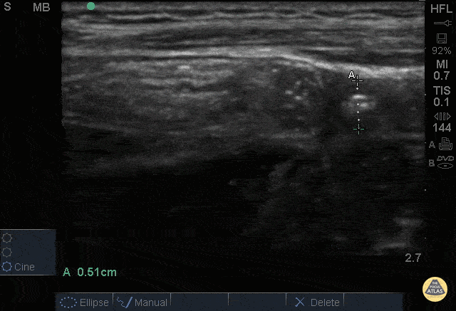 Bowel-GI - Normal Appendix - Cross Section Measured