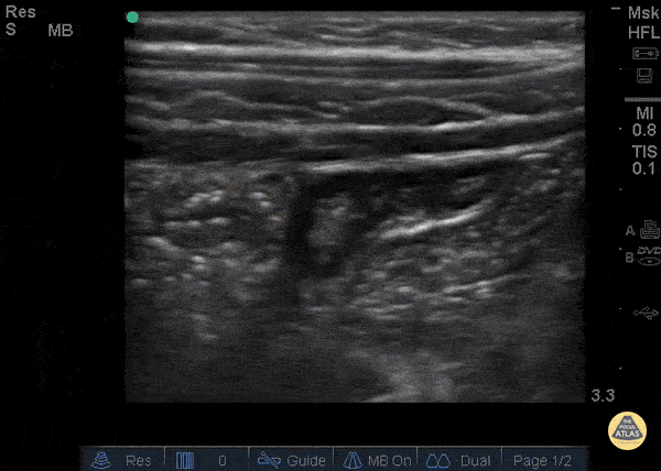 Bowel-GI - Normal Appendix - Blind End