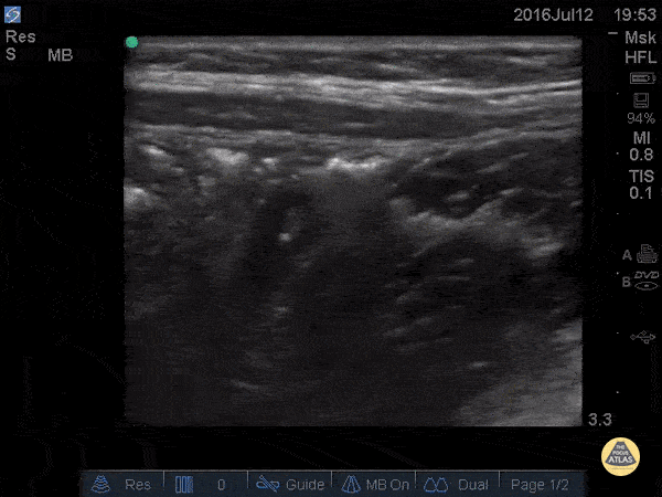 Peds-Gastrointestinal - Normal Appendix - Cross Section