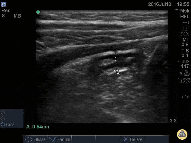 Peds-Gastrointestinal - Normal Appendix - Cross Section Measured