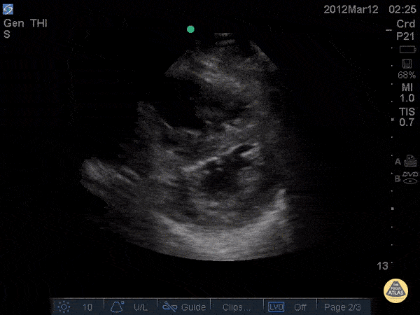 Right Ventricular Dysfunction - D-Sign in acute PE - Pre TPA