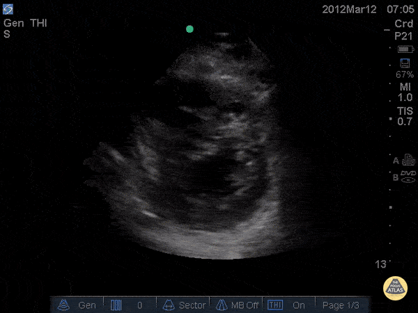 Right Ventricular Dysfunction - D-Sign in acute PE - Post TPA