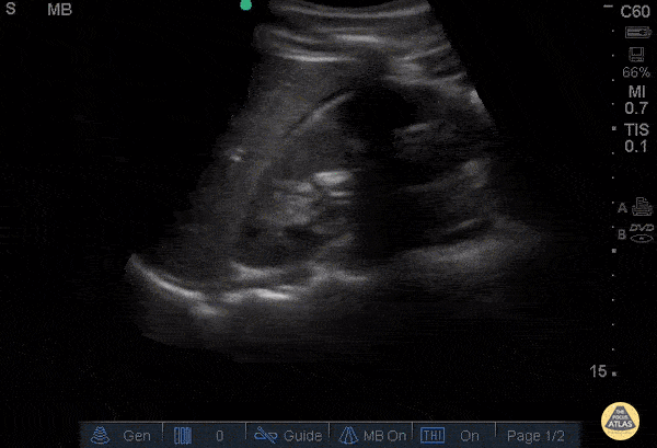 Trauma - Positive FAST - RUQ