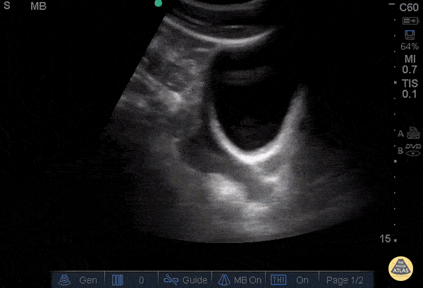 Trauma - Positive FAST - Pelvis
