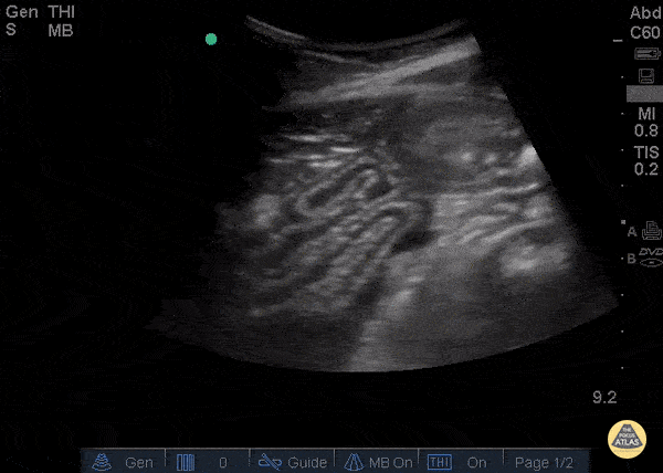 Bowel-GI - Free fluid and Collapsed Bowel