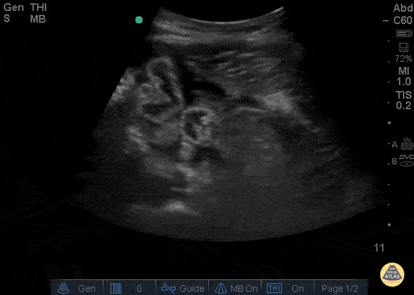 Bowel-GI - Free Fluid and Collapsed Bowel