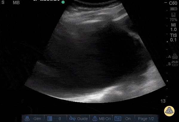 Renal/GU - Severe Hydronephrosis