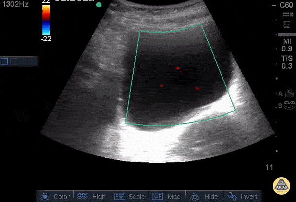 Renal/GU - Decreased Right Ureteral Jet
