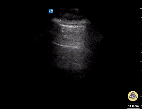 Pulmonary - A - Lines - Normal Lung