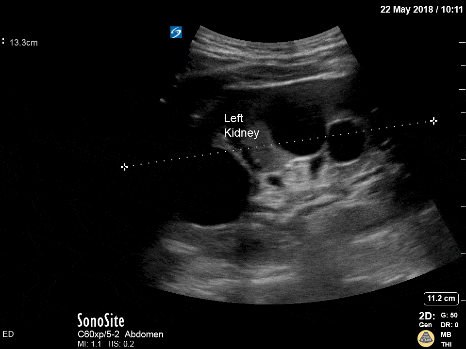 Renal/GU - Polycystic Kidney