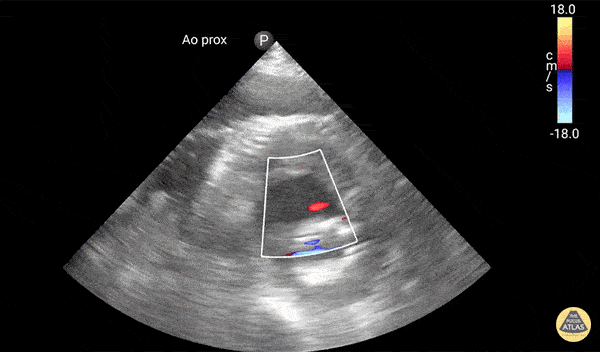 Vascular - Color Extravasation