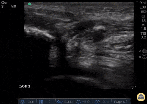Musculoskeletal - Patellar Tendon Rupture Longitudinal