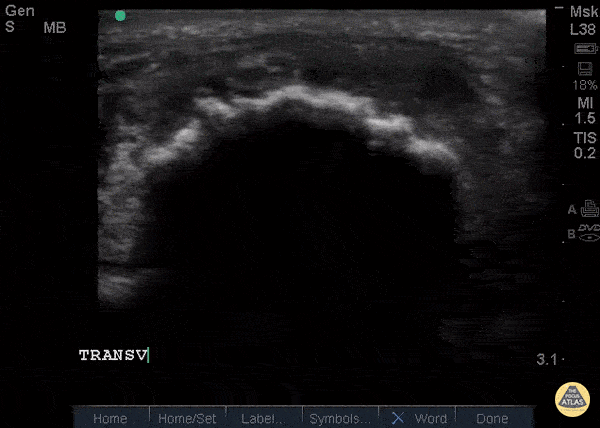 Musculoskeletal - Patellar Tendon Rupture Transverse