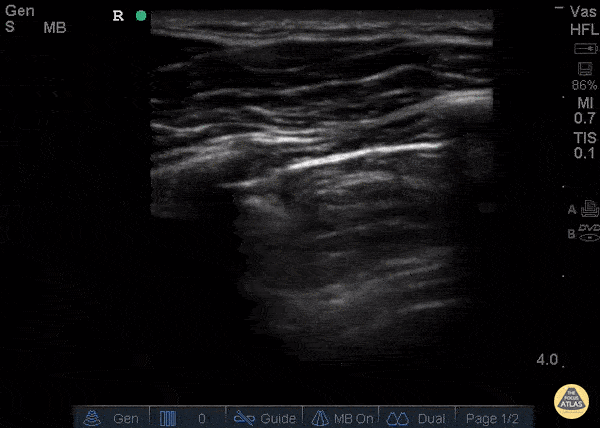 Pulmonary - Decreased Lung Slide - Pneumothorax