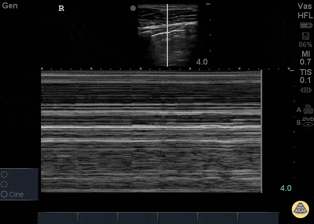 Pulmonary - Bar Code Sign - Pneumothorax