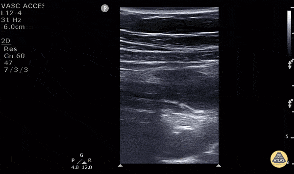 Peds-Gastrointestinal - Appendicitis (1/2) - Longitudinal