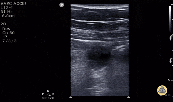 Peds-Gastrointestinal - Appendicitis (2/2) - Transverse