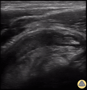 Blog - Bedside Ultrasound For Acute Appendicitis - Featuring Colorized Images