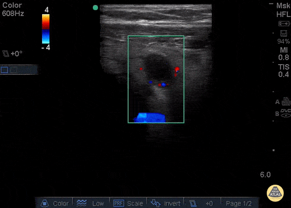 Blog - Bedside Ultrasound For Acute Appendicitis - Featuring Colorized Images