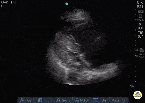 Right Ventricular Dysfunction - Right Heart Thrombus pre TPA