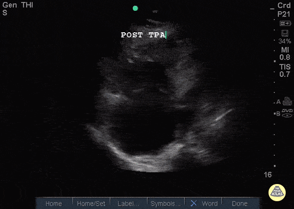 Right Ventricular Dysfunction - Right Heart Thrombus post TPA