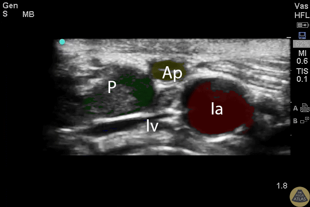 Colorized Appendicitis - Labeled Colorized Appendix with Landmarks