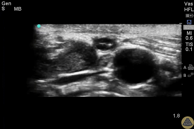 Colorized Appendicitis - 2D Appendix Landmarks