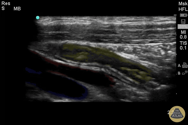 Colorized Appendicitis - Colorized Appendix with Landmarks (Longitudinal)