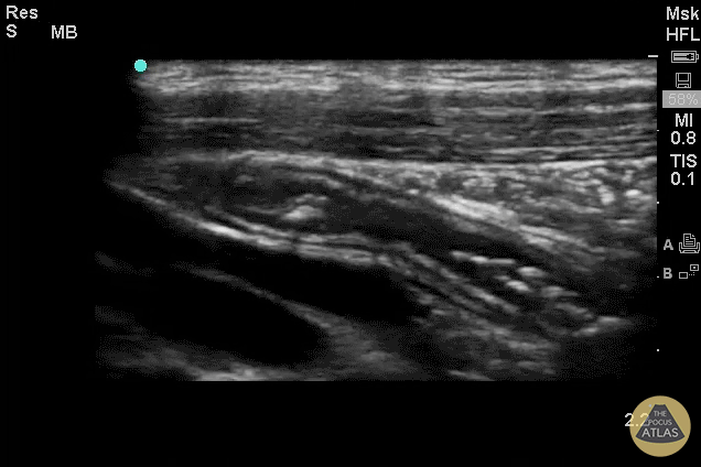 Colorized Appendicitis - 2D Appendix with Landmarks (Longitudinal)