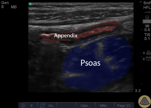 Colorized Appendicitis - Labeled and Colorized Appendix and Psoas
