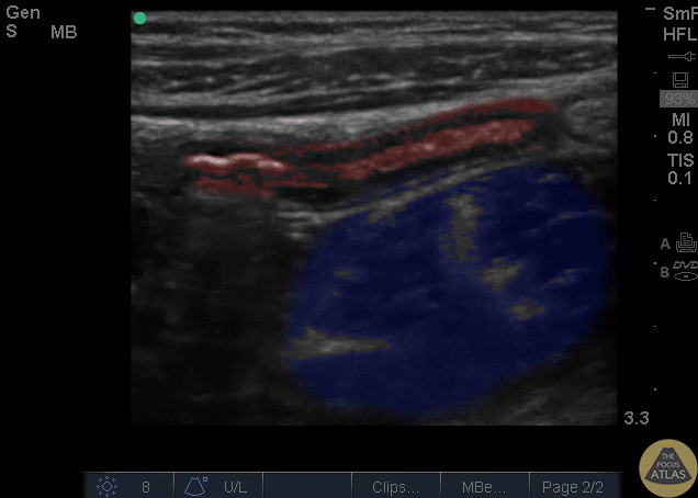Colorized Appendicitis Images - Colorized Appendix and Psoas