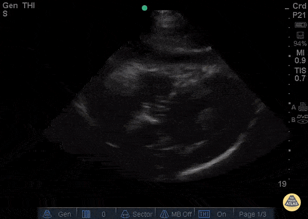Pericardial Disease - Exudative Effusion