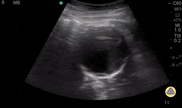 Aorta - Mural Thrombus in AAA